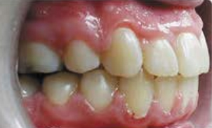 Right Bite for Virtual Photo