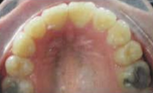 Upper Occlusal for Virtual Photo