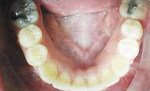 Lower Occlusal for Virtual Photo