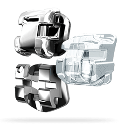 Damon brackets for braces